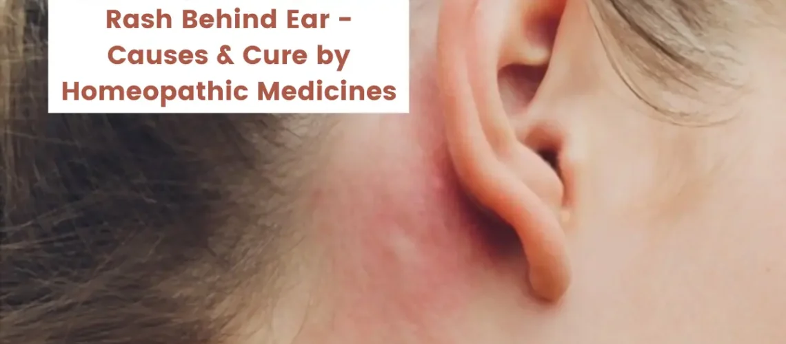 Rash Behind Ear - Causes and Treatment by Homeopathy Medicines