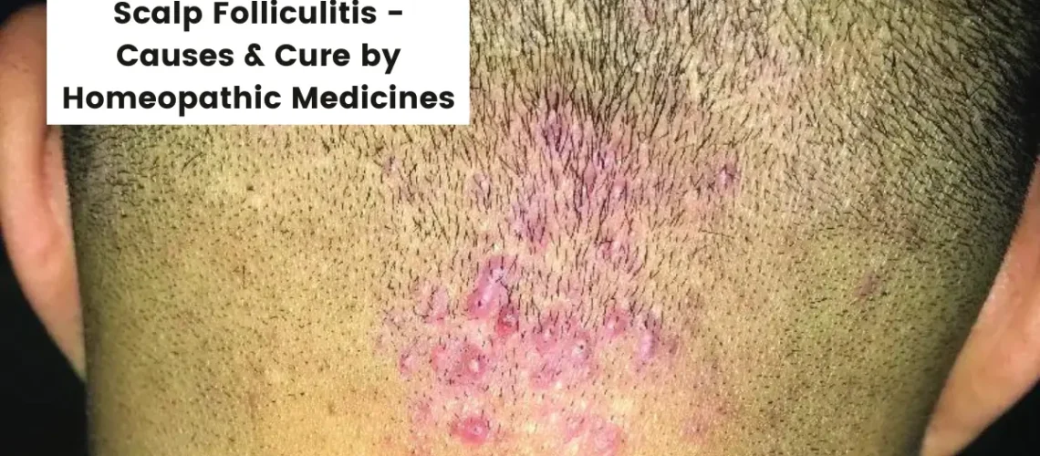 Scalp Folliculitis Treatment Causes Cure By Homeopathy