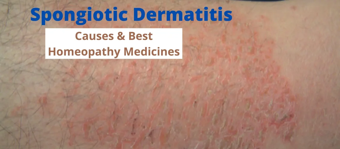 Spongiotic Dermatitis Causes, Symptoms & Treatment
