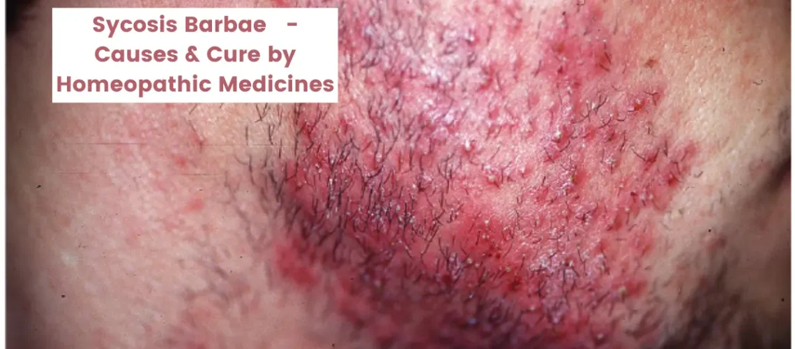 Sycosis Barbae - Causes, Symptom, Best Homeopathic Medicine